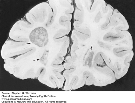 Brain Imaging of Demyelination in Multiple Sclerosis 