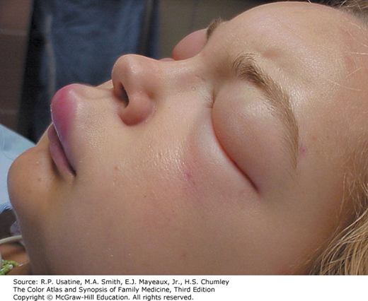 Angioedema of Eyes and Mouth