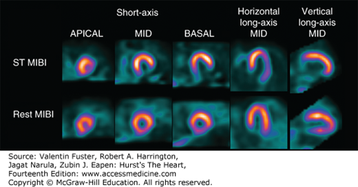 Adenosine Stress/Rest Myocardial Perfusion Single-Photon Emission Computed Tomography 