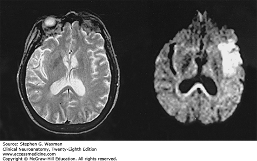 Diffusion MRI of Cerebral Infarct 