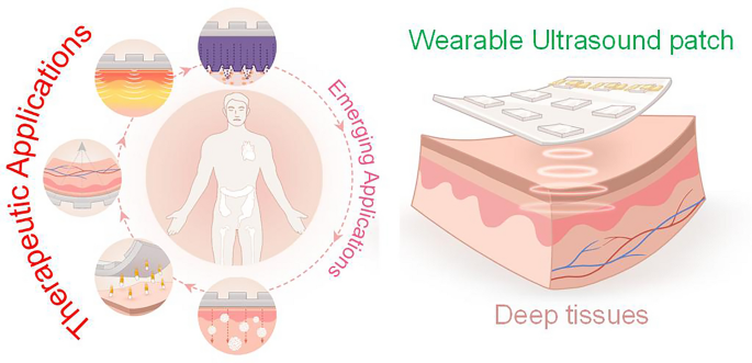 Wearable Ultrasound Devices for Therapeutic Applications