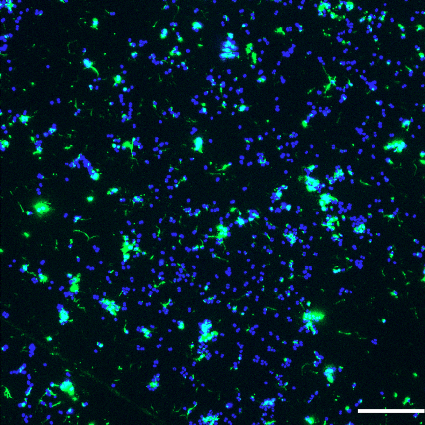 How MDA Phages Select Hyperadhesive Variants in Neisseria meningitidis?