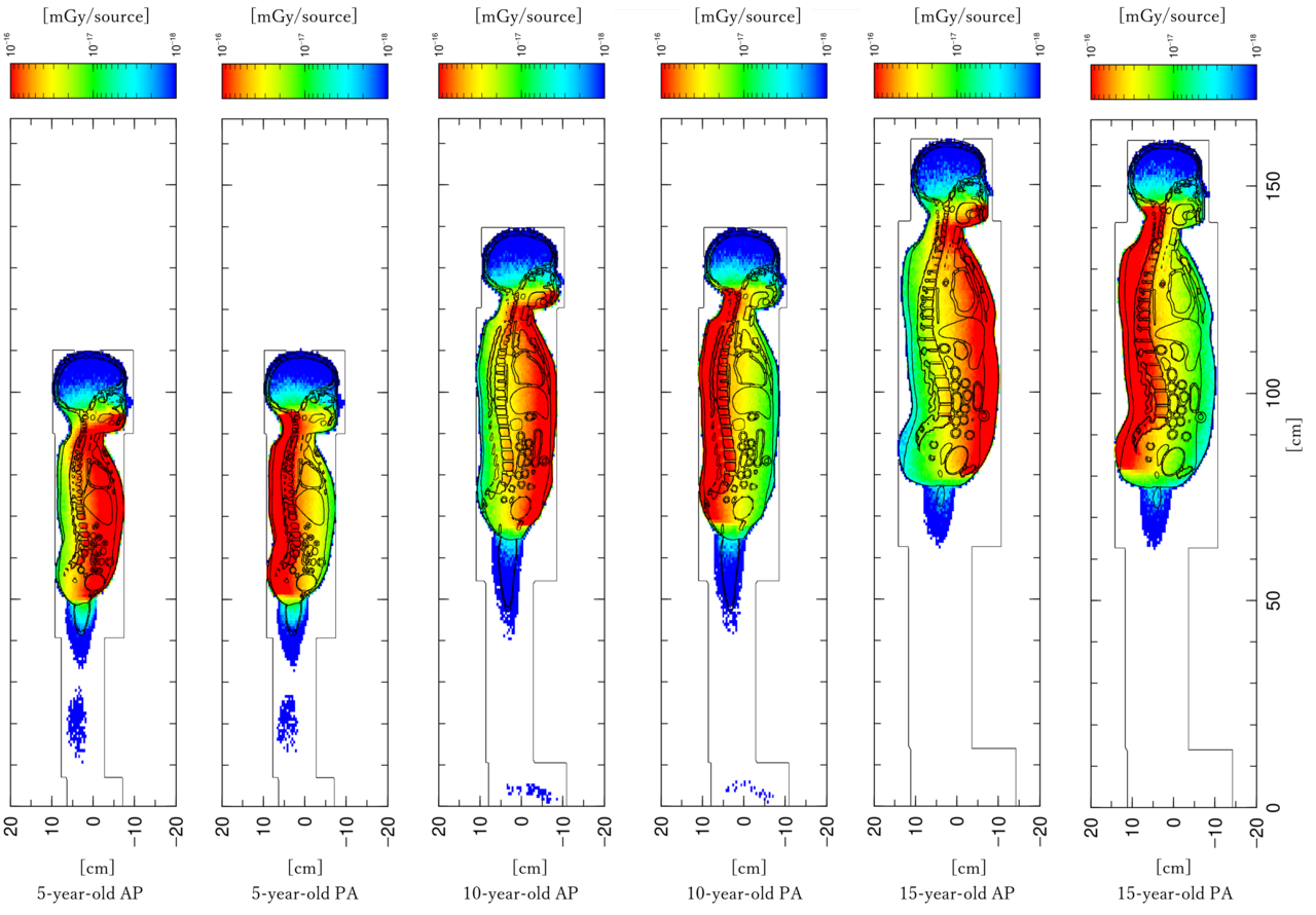Why projection direction matters in pediatric full-spine radiography