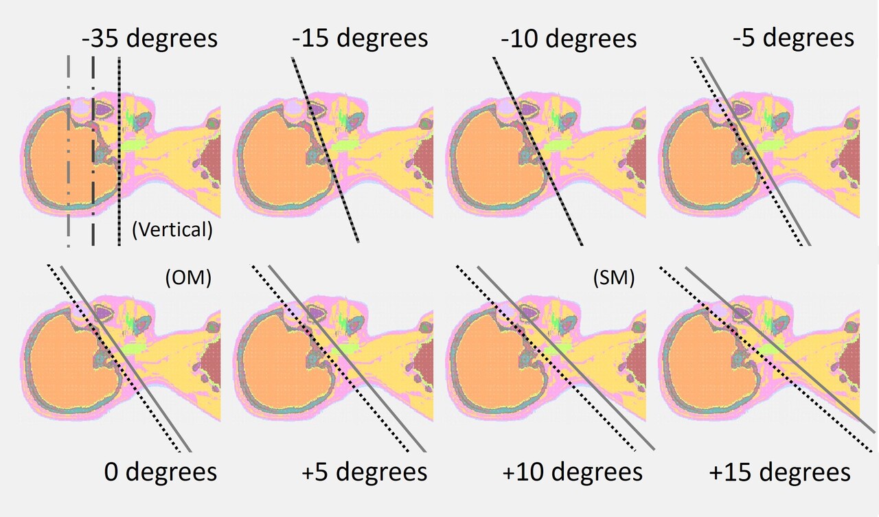 Why Gantry Tilt Alone Is Not Enough in Head CT: Visualizing Eye Lens Dose Distribution with Monte Carlo Simulation