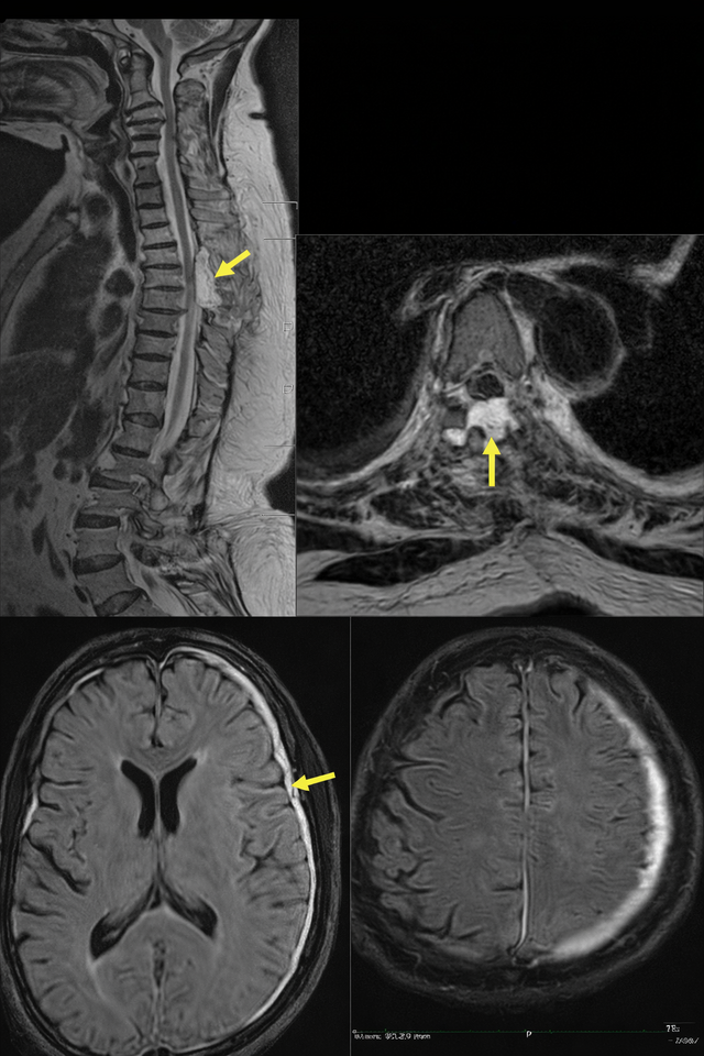 Remote intracranial hemorrhage after supratentorial and spinal surgery: a three case series and review of literature