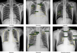 VinDr-CXR:  The largest public chest X-ray  dataset with radiologist-generated annotations for machine learning-based computer-aided diagnosis (CAD)  