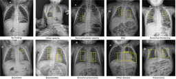 PediCXR: Advancing the interpretation of common thoracic diseases in children