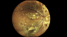 Macular degeneration Collection - Scientific Reports