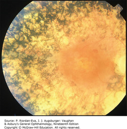 AccessMedicine's Image of the Week: Retinitis Pigmentosa 