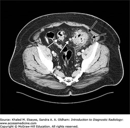 AccessMedicine's Image of the Week: Diverticulitis on CT Abdomen