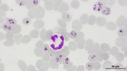 Unlocking New Frontiers in Cerebral Malaria Diagnosis and Treatment: The Promise of Methylene Blue and Blood Biomarkers