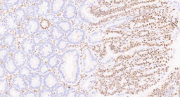 Cancer, Translation Stress and NPM1,  a New Cancer Vulnerability