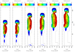 Why projection direction matters in pediatric full-spine radiography