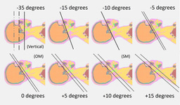 Why Gantry Tilt Alone Is Not Enough in Head CT: Visualizing Eye Lens Dose Distribution with Monte Carlo Simulation