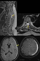 Remote intracranial hemorrhage after supratentorial and spinal surgery: a three case series and review of literature