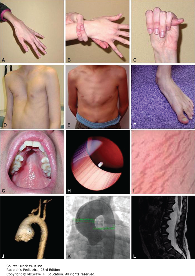 Syndrome De Marfan Marfan Syndrome Symptoms And Causes Mayo Clinic Syndrome De Marfan Marfan Syndrome Symptoms And Causes Mayo Clinic