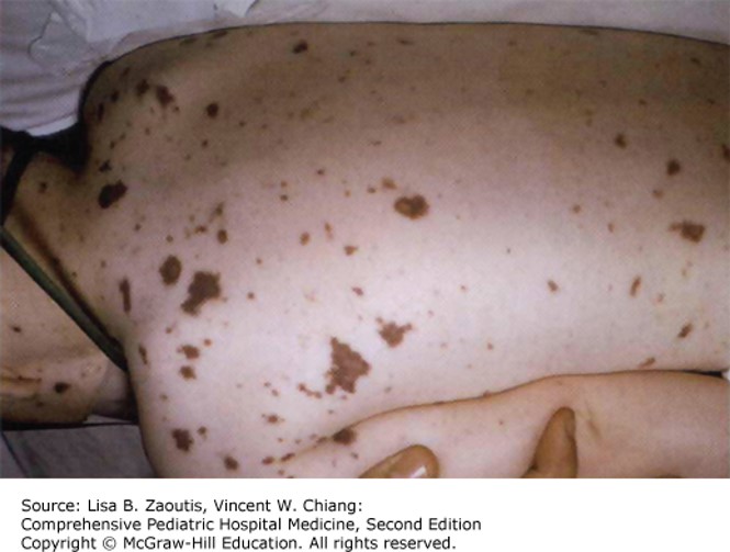 Septic Diffuse Rash Septic Shock Rash