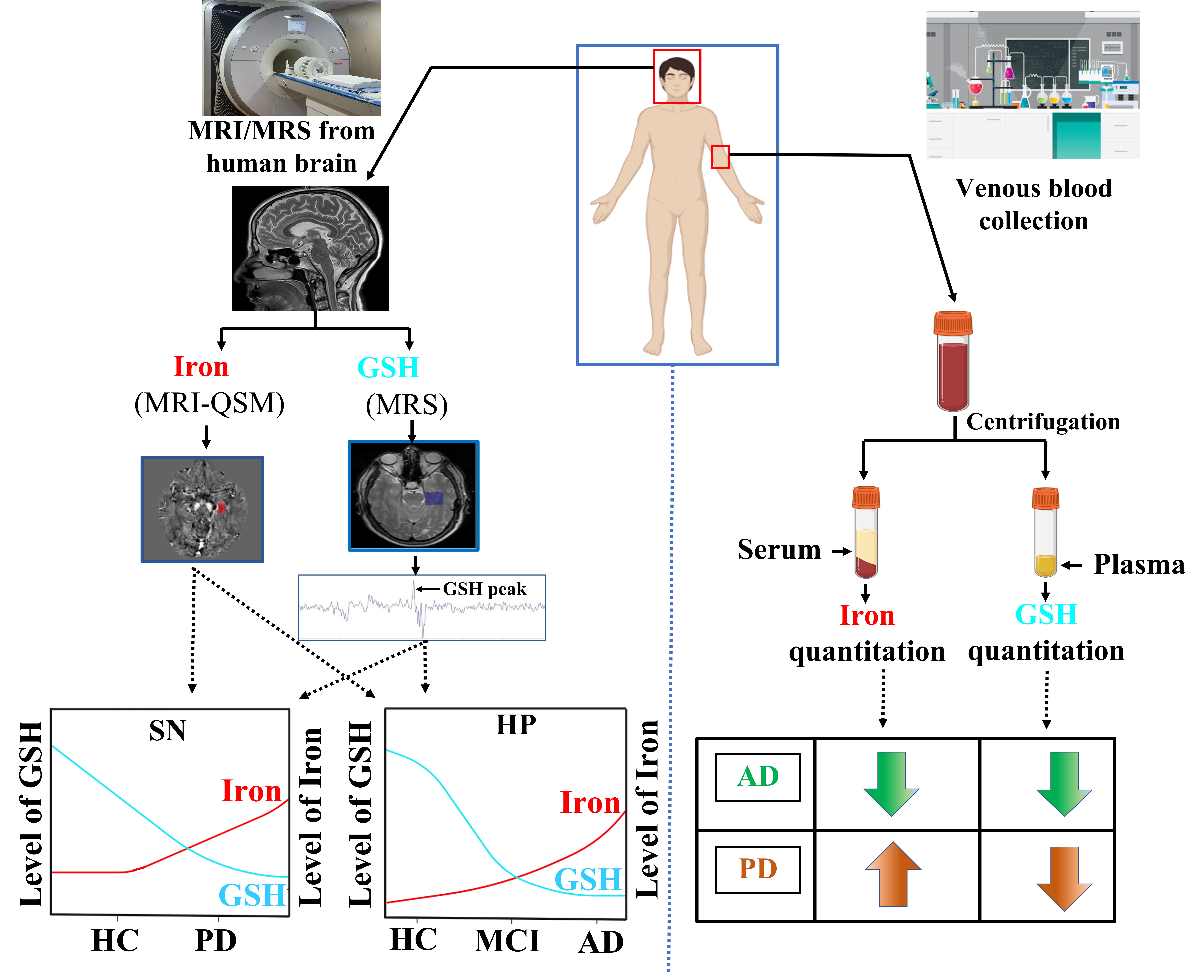 Glutathione and Iron Interplay in Alzheimer's: A Clue for Intervention?
