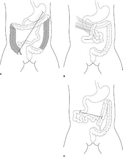 Pediatric Gastroenterology Case