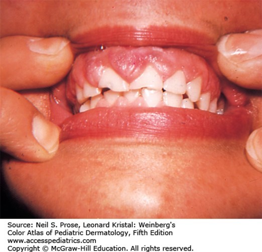Drug Eruptions Diagnosis 