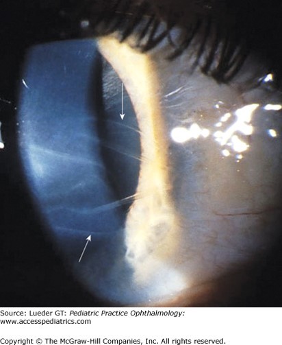 Cloudy Cornea Diagnosis