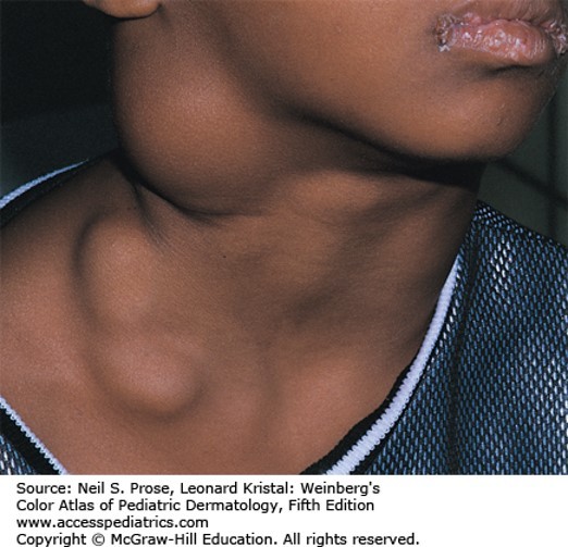 Neoplastic Disorders Diagnosis 