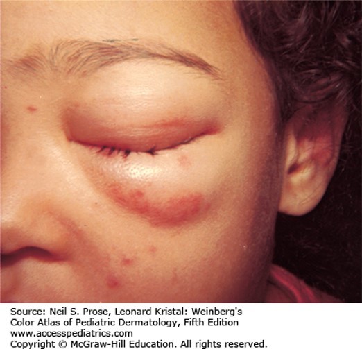 Urticarial, Purpuric, and Vascular Reactions Diagnosis 