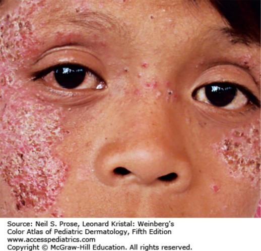 Photodermatoses Diagnosis