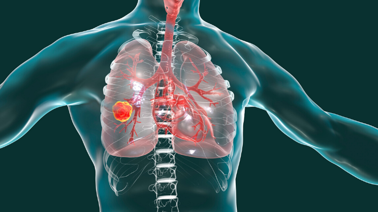 Could COPD represent an independent risk factor for lung cancer? | The