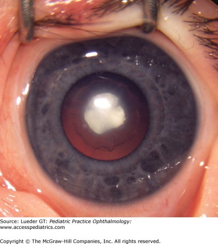 Eye Lens Disorders Diagnosis