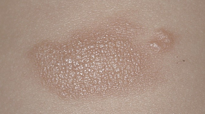 Dermatology Case