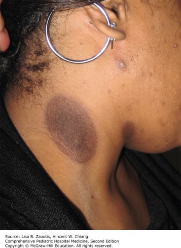 Drug-Associated Rashes Diagnosis