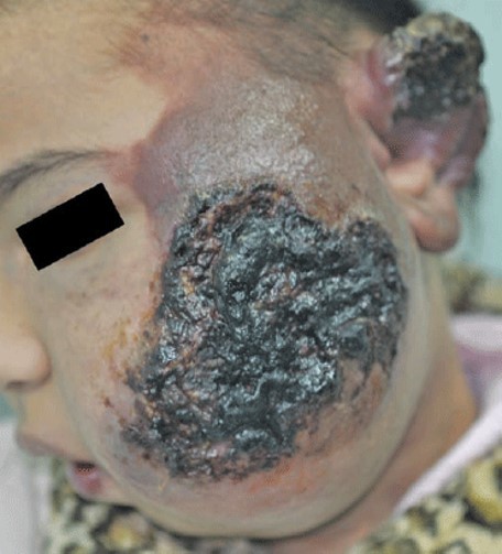 Vascular Anomalies Diagnosis