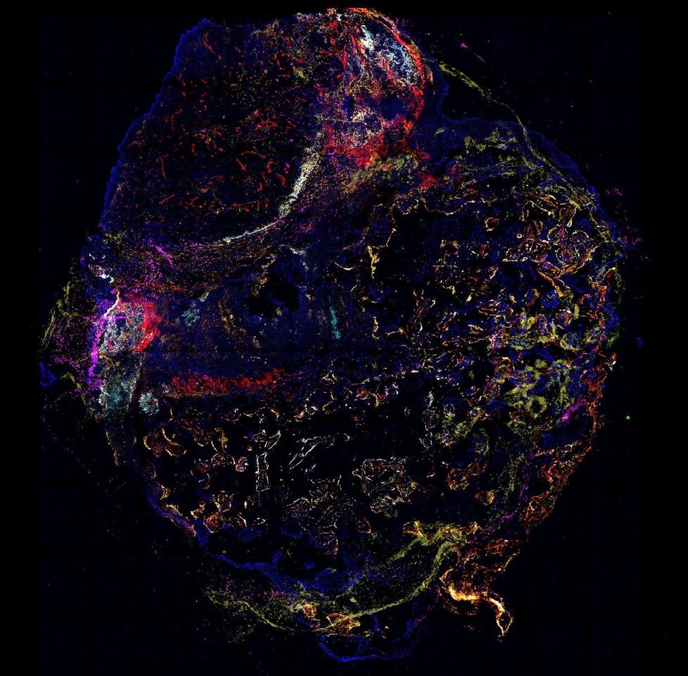 Engineered Humanized Microenvironments Expose the Awakening Tumor Niche