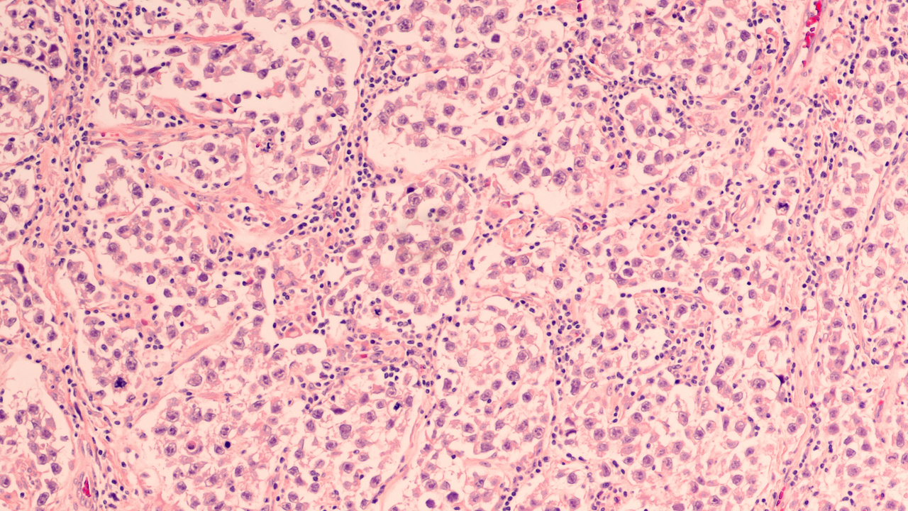 Testicular cancer responds well to ‘kinder chemo’ OnMedica