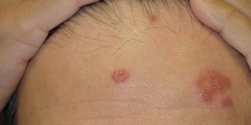 Facial Rashes Clinical Images Challenge Facial Skin Lesions OnMedica