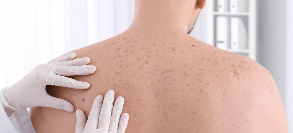 Direct to consumer Skin Cancer Detection Apps Are Failing To Detect 