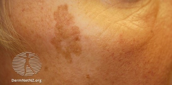Clinical Image Challenge Brown Flat Lesion On The Face Of A Fair 