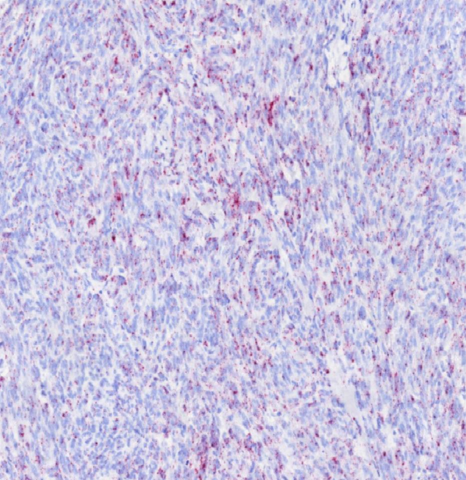 SK1 a checkpoint lipid kinase for immunotherapy
