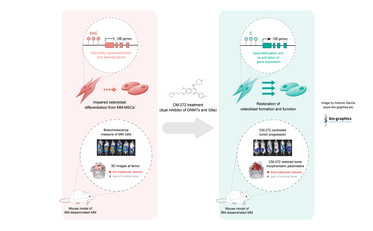 Epigenetics as a new target for treatment of bone disease in multiple myeloma