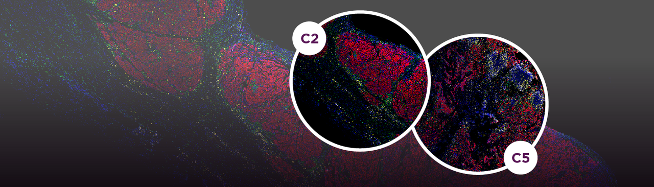 Clonal architecture in Mesothelioma is prognostic and shapes the tumour microenvironment