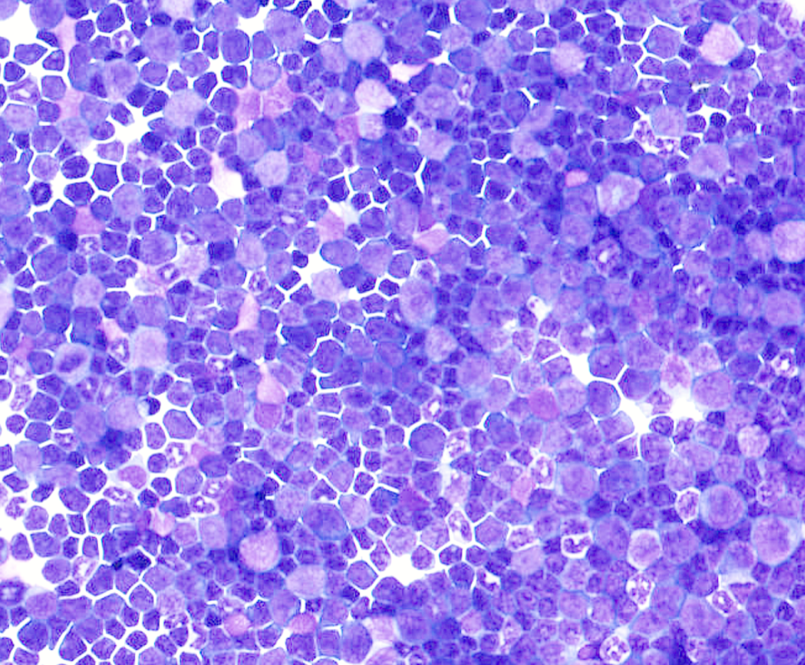 CUX1 haploinsufficiency antagonizes apoptosis to sustain AML