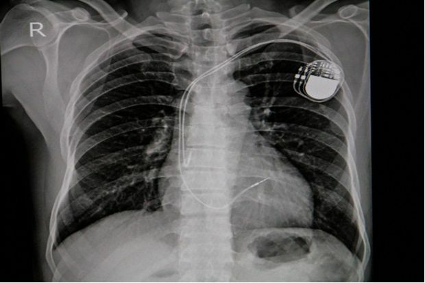 What advice can you give to a patient having a pacemaker fitted?