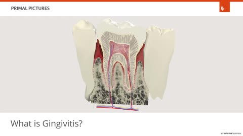 gingivitis