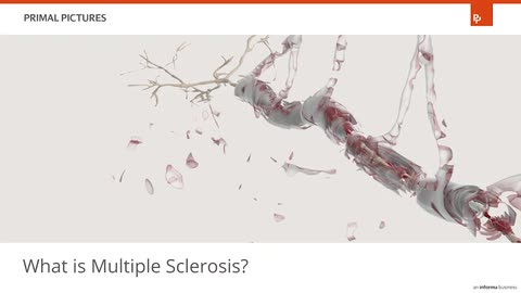 Multiple sclerosis
