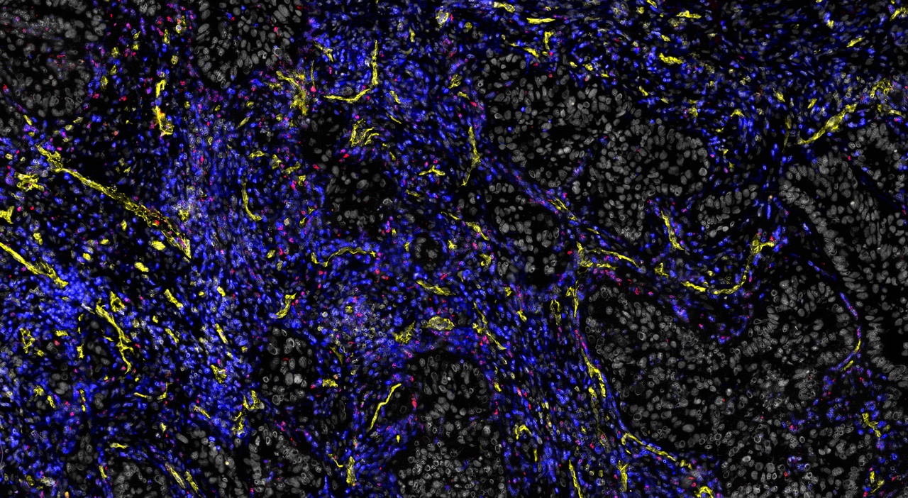 Reaching for the stars: Charting the immune landscape of brain tumours through time and space