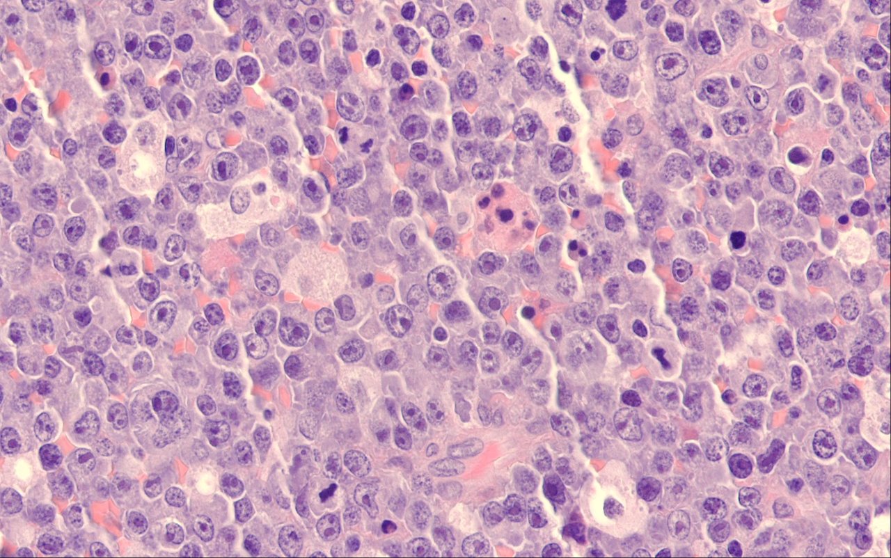 Molecular and functional profiling identifies therapeutically targetable vulnerabilities in plasmablastic lymphoma