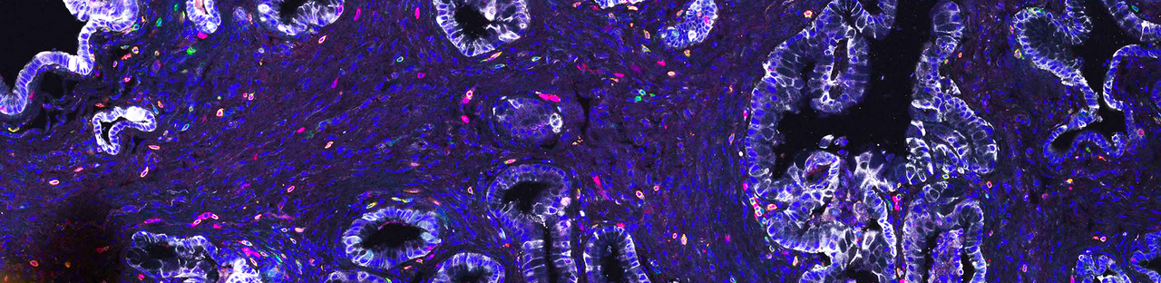 Cold tumors inflame - make mesenchymal pancreatic cancers vulnerable to immunotherapies