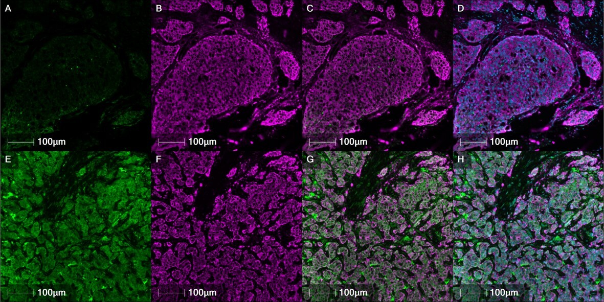 Osteopontin: a new therapeutic alarm clock in breast cancer recurrence 
