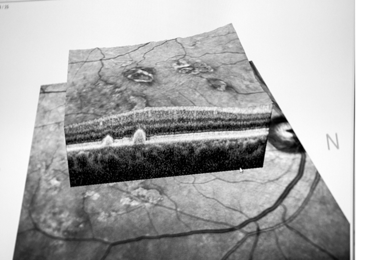 Call for papers: Glaucoma genetics Collection